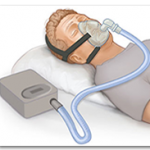 CPAP therapy