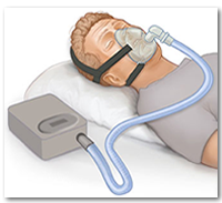 An Alternative to CPAP Therapy Non Compliance